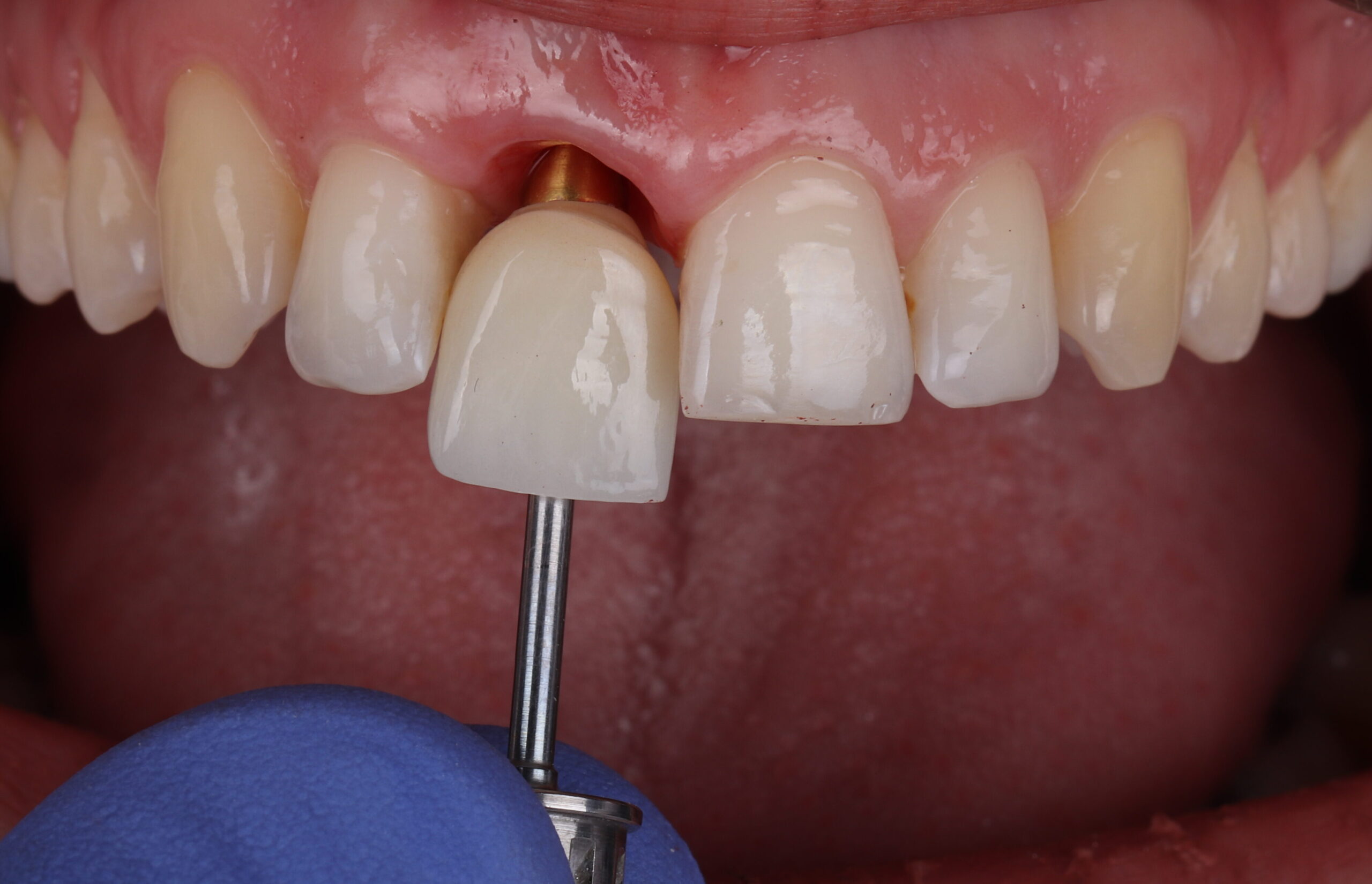 Dentalni implantat i izbor implantološkog sistema