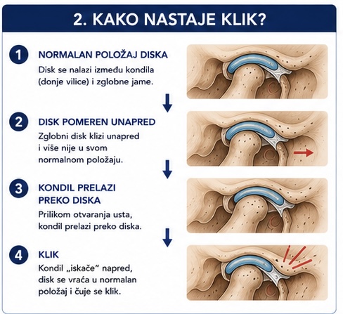 Kako nastaje klik u viličnom zglobu