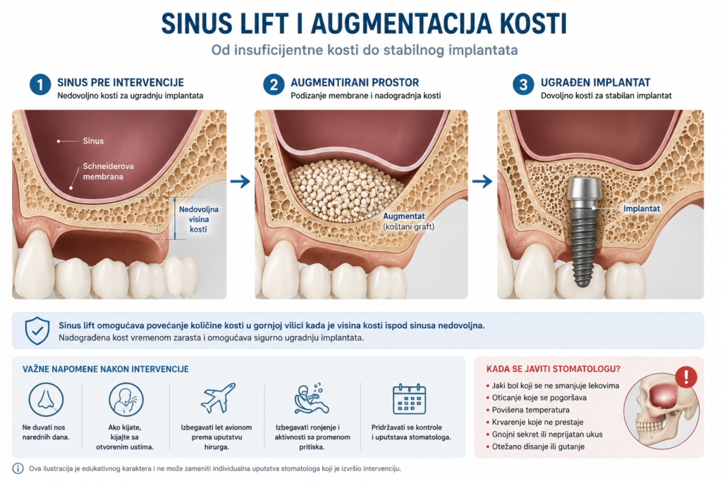 Sinus lift i nadogradnja kosti pre implantacije