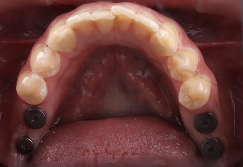 Dentalni implantati nakon ugradnje u vilicu